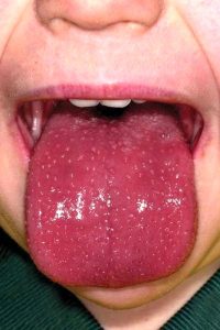 بیماری زبان توت فرنگی