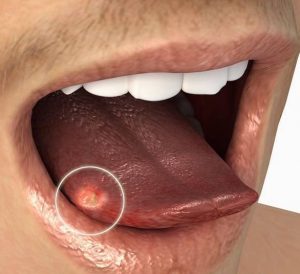 بیماری سرطان زبان
