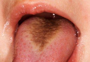 بیماری زبان مودار سیاه