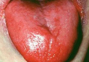 بیماری التهاب زبان